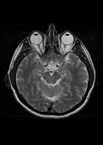 頭部MRI検査の画像です